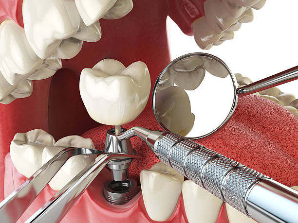 Best Emergency Wisdom Teeth Removal in Florham Park, NJ